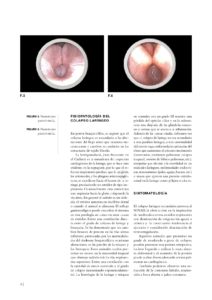 articulo revista Colapso laringeo y CO2 003
